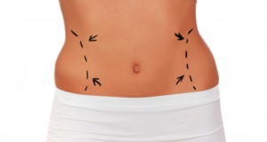 LIPOSUKSION